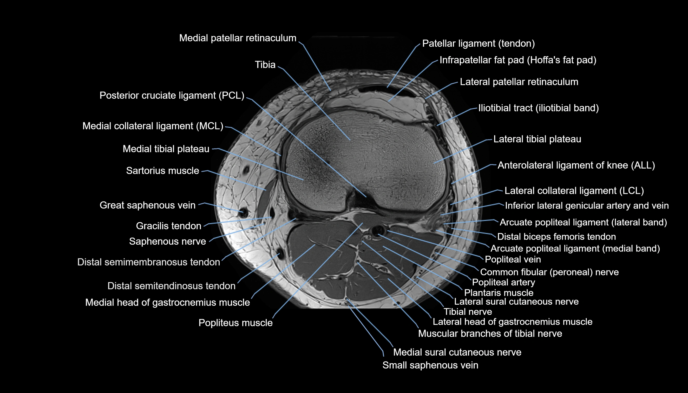 MRI knee  axial cross sectional anatomy 3T radiology  image-img-00001-00033.webp